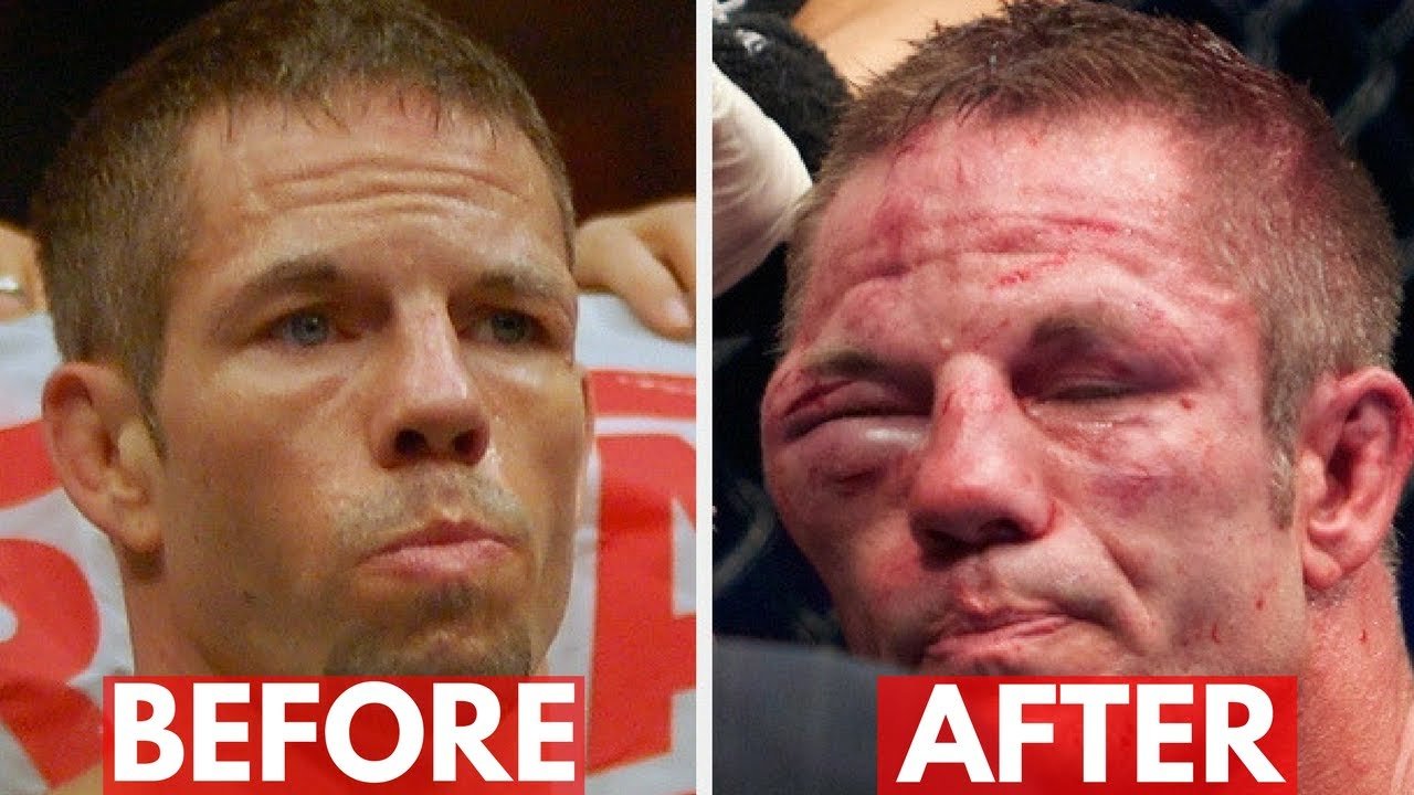 Ufc Fighters Post Fight Videos Of Injuries.
